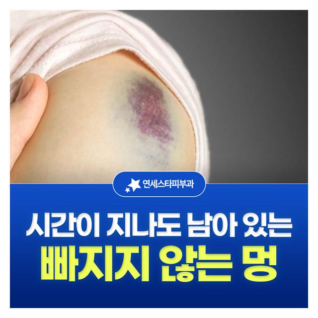 빠지지 않는 멍, 시간이 지나도 남아 있는 멍도 진료합니다
